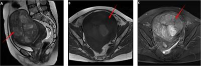 Intraperitoneal spread in uterine sarcoma following unprotected laparoscopic transvaginal uterine morcellation: a case report and literature review